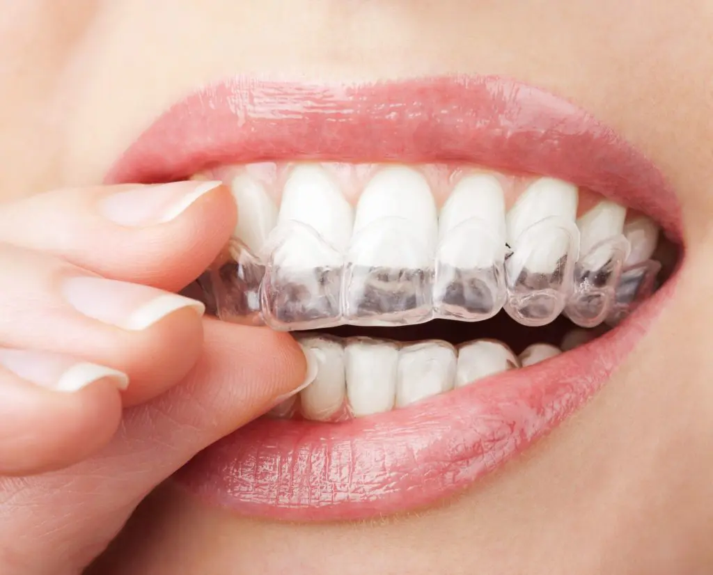 Invisalign - Maxdent Wrocław