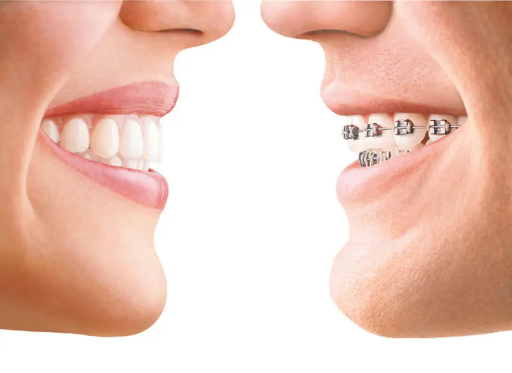 Invisalign - Maxdent Wrocław